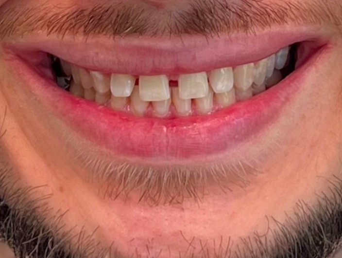 Szpary między zębami i nieprawidłowe zwarcie przed metodą Flow Injection.