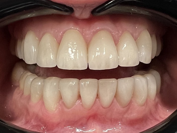 Harmonijne dziąsła i naturalne licówki ceramiczne e.max z uzupełnieniami typu vonlay.