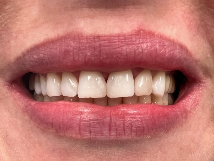 Siekacze górne przed korektą estetyczną licówkami porcelanowymi.