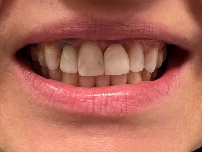 Nierówna linia dziąseł przed zabiegiem periodontologicznym.