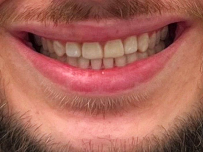 Zdjęcie po przebudowie zwarcia metodą flow-injection