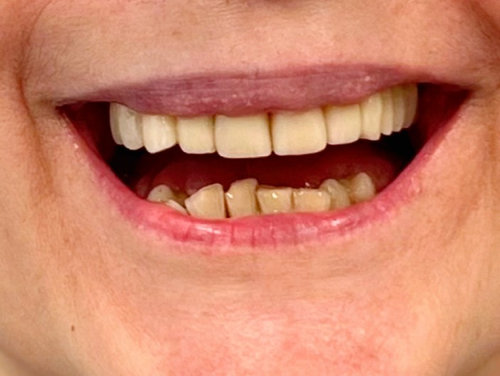 Zdjęcie po założeniu koron cyrkonowych