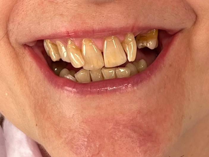 Zdjęcie przed założeniem koron cyrkonowych