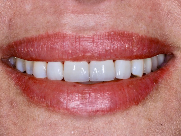 Zdjęcie po założonych licówkach porcelanowych