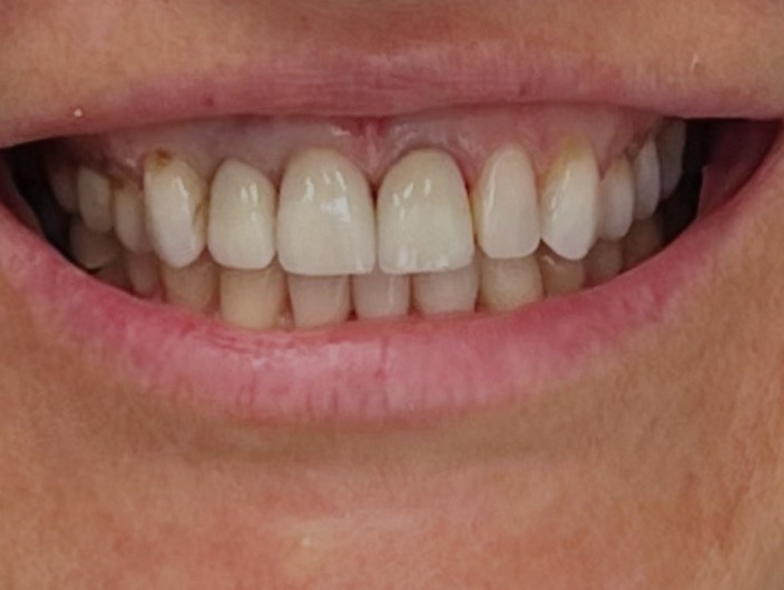 Zdjęcie po wyrównaniu girlandy dziąsłowej